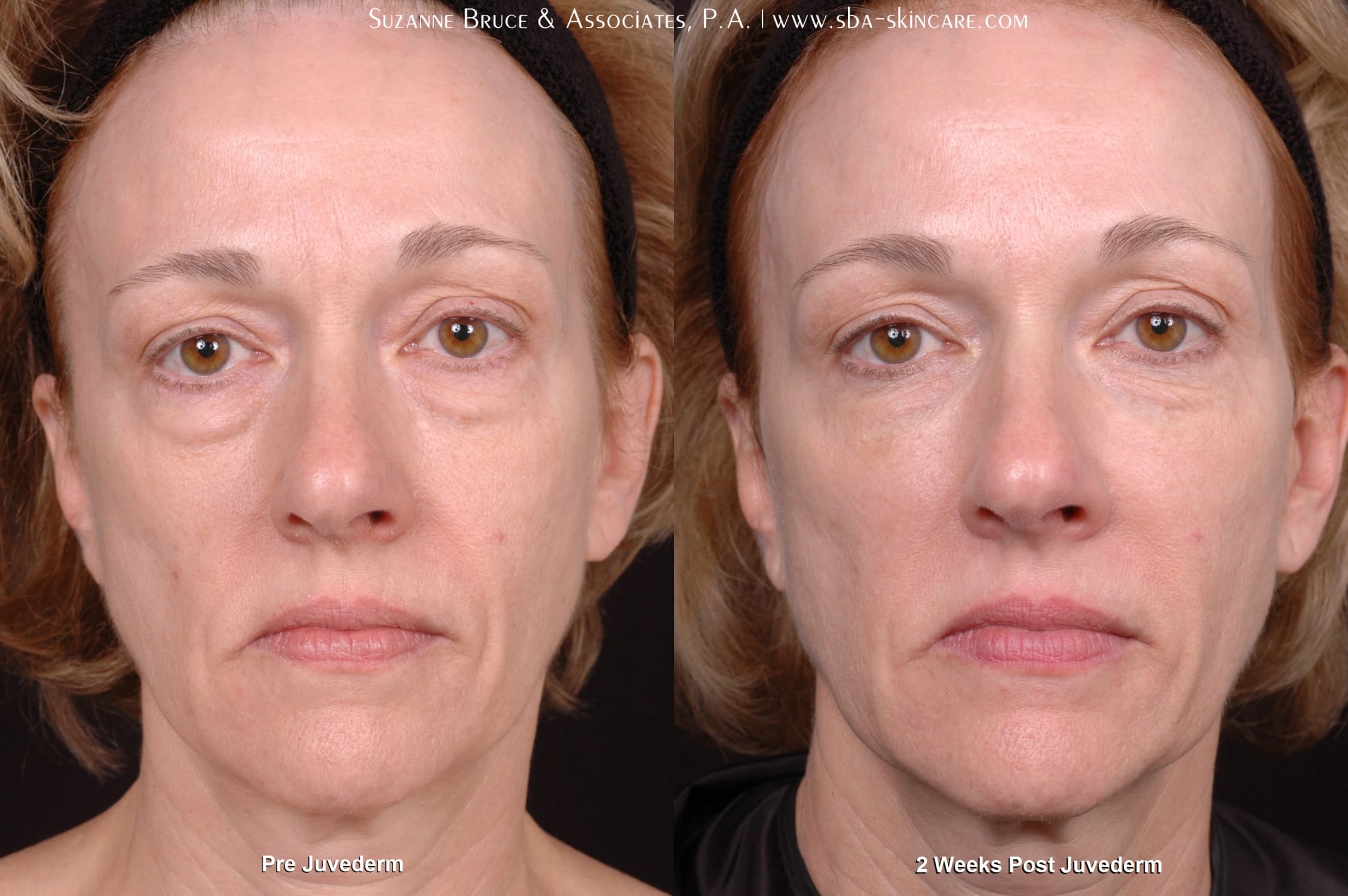 Under Eye Filler Before And After Pictures Goo To Play