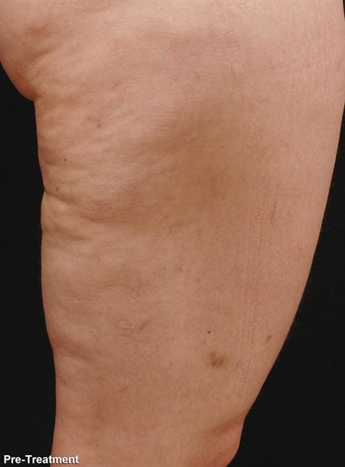 VelaShape™ Before and After Images