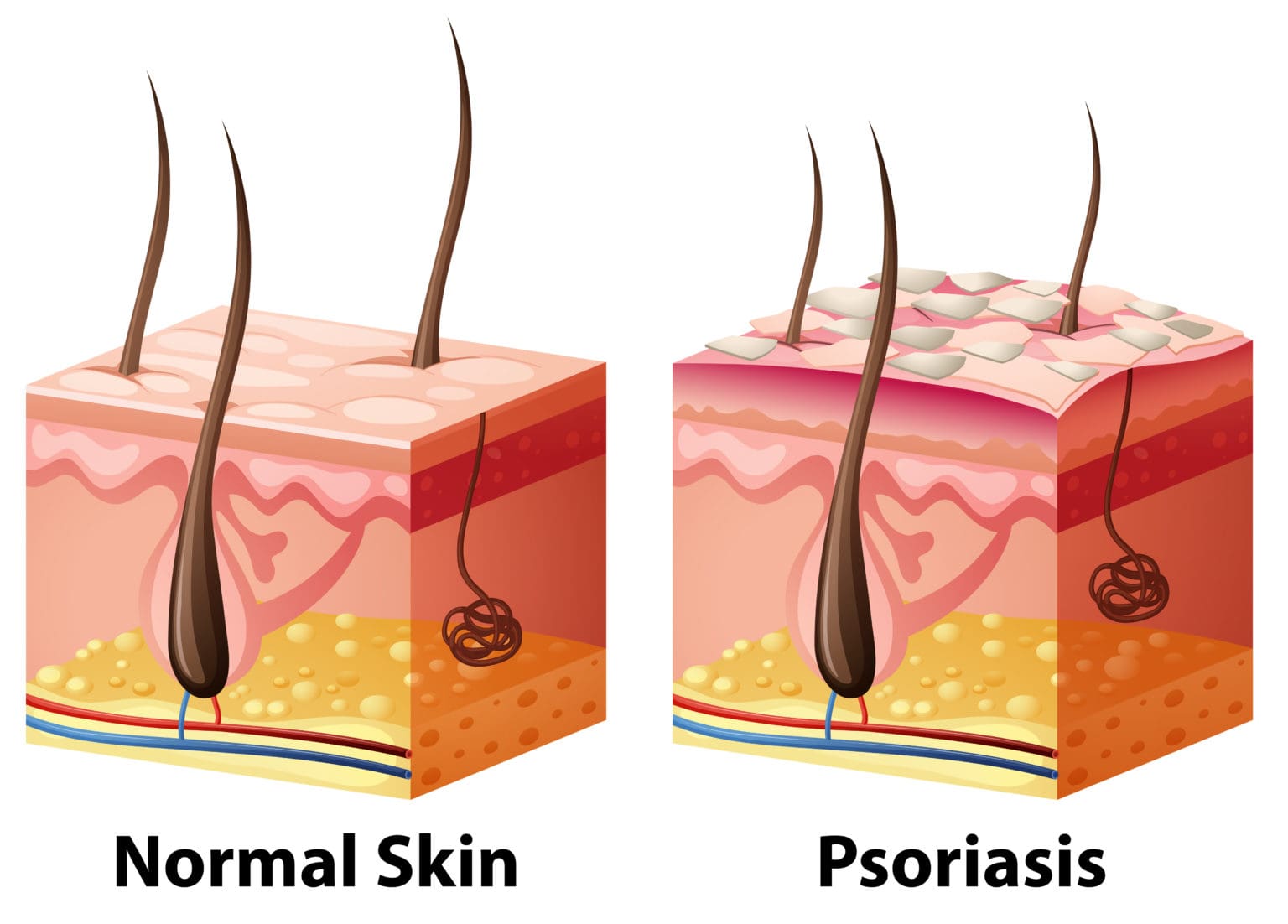 Top 4 Dermatologist Recommended Treatments For Psoriasis Sba Dermatology 