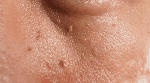 Understanding Skin Tags: Causes and Treatment Options - SBA Dermatology